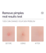 6211 PIMPLE PATCH 36PC - Image 5